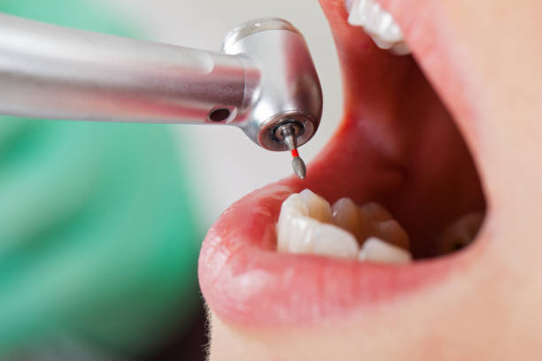 Best Emergency Tooth Extraction in Perris, CA